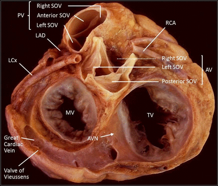 Ventricular tachycardia in the absence of structural heart disease | Heart
