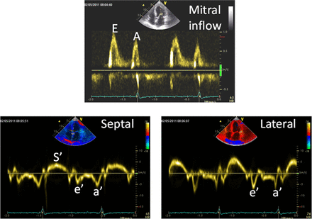 Ms Inflow Signal Echo-Doppler assessment of diastole: flow, function and haemodynamics ...